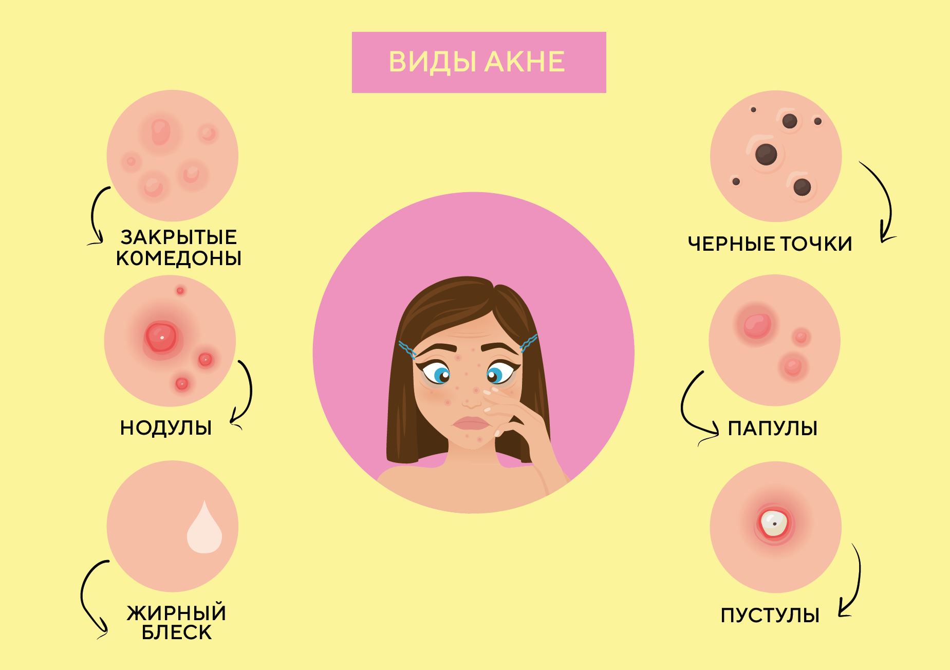 виды акне.JPG