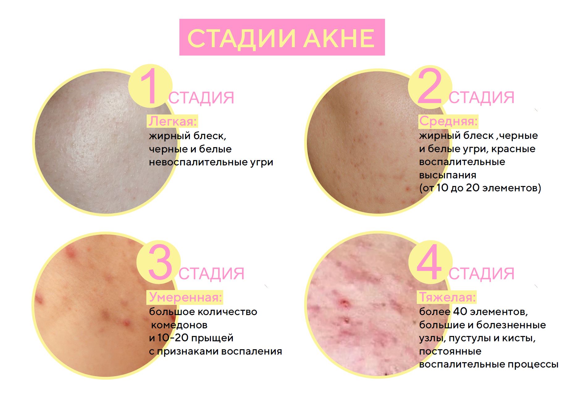 стадии акне.JPG
